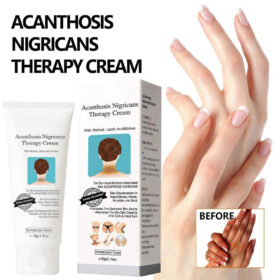 Acanthosis Nigricans Cream – Dark Spot Corrector with Retinol for Neck, Underarms, Elbows, Knees, Knuckles, Thighs & Ankles – Helps Improve Uneven Skin Tone & Hyperpigmentation Appearance
