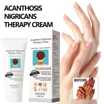 Acanthosis Nigricans Cream – Dark Spot Corrector with Retinol for Neck, Underarms, Elbows, Knees, Knuckles, Thighs & Ankles – Helps Improve Uneven Skin Tone & Hyperpigmentation Appearance